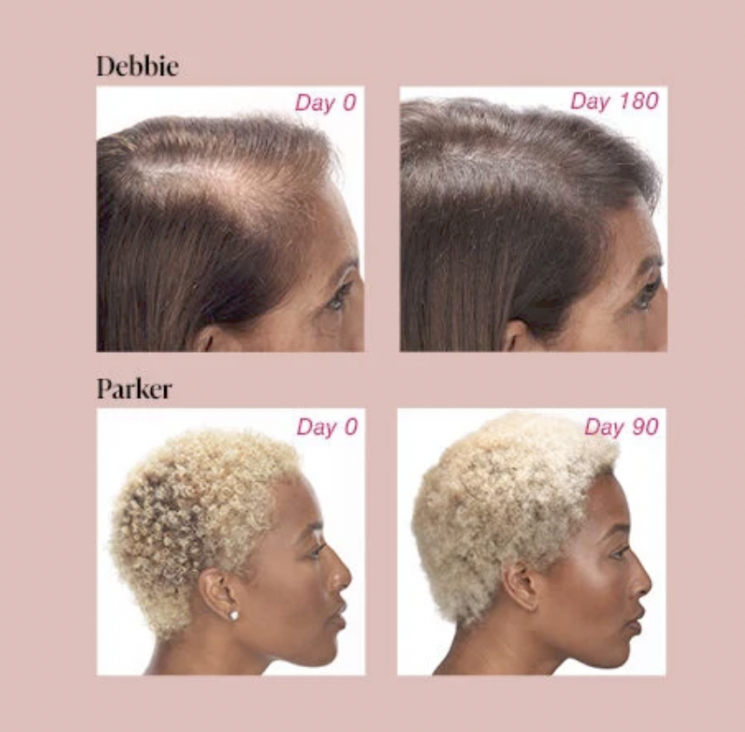 Viviscal Hair Supplement - Clinical Results