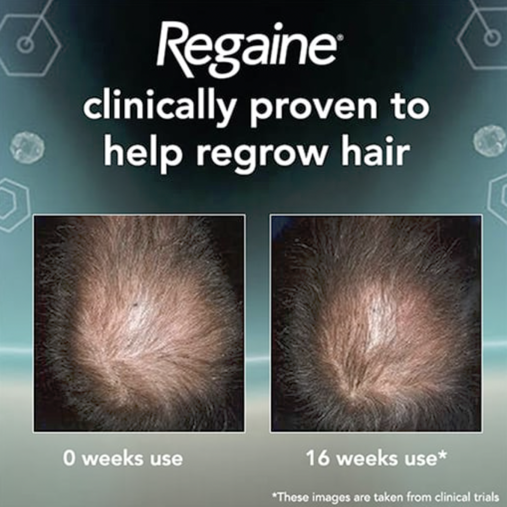 Before & After Images of Rogaine for Men (Regaine in the UK)