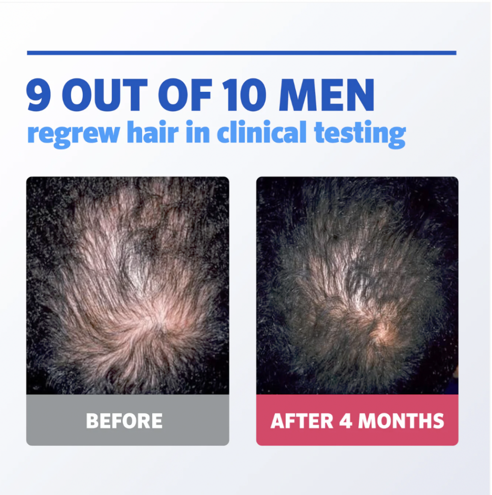 Before & After Images of Rogaine for Men