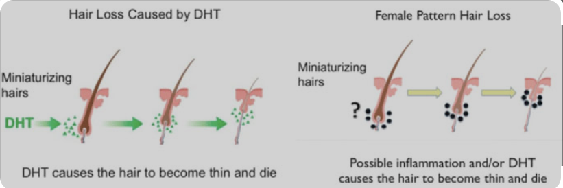 Hair Loss Caused by Dihydrotestosterone (DHT)