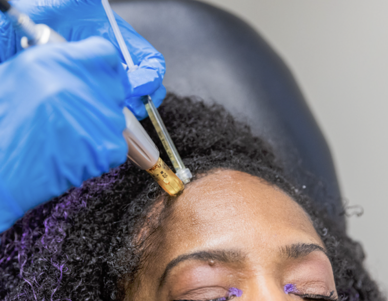 Polynucleotide (PN) Treatment for Hair Loss