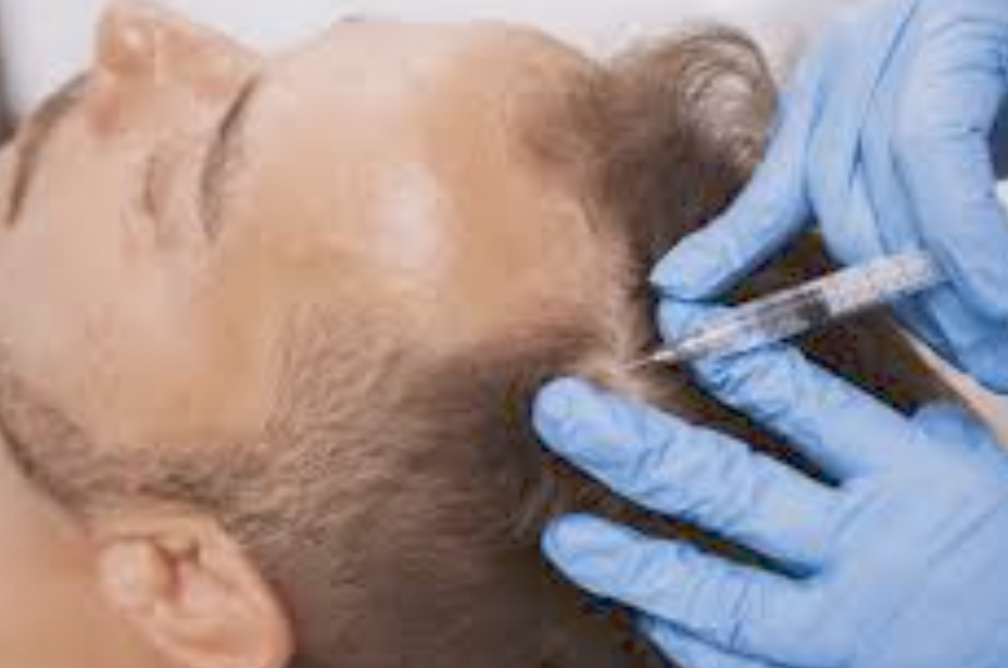 Polynucleotide (PN) Treatment for Male Hair Loss