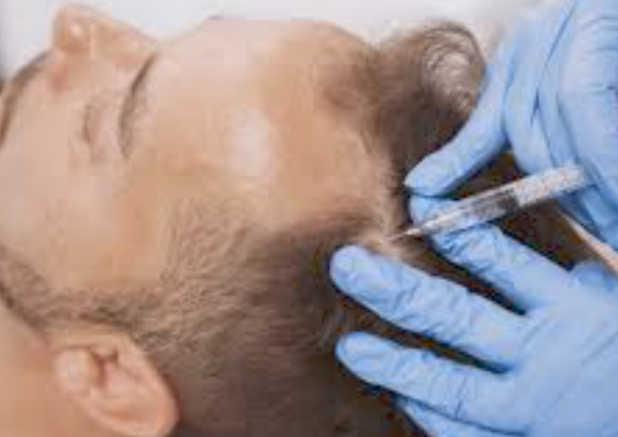 PRP Injections for Hair Loss
