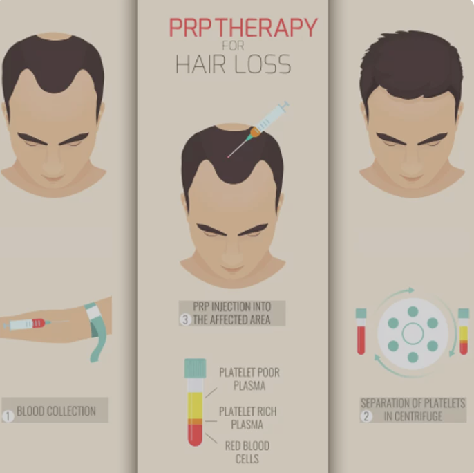 PRP Therapy for Hair Loss