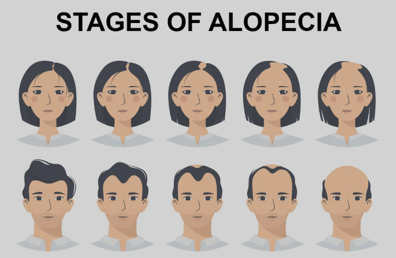 Stages of Alopecia