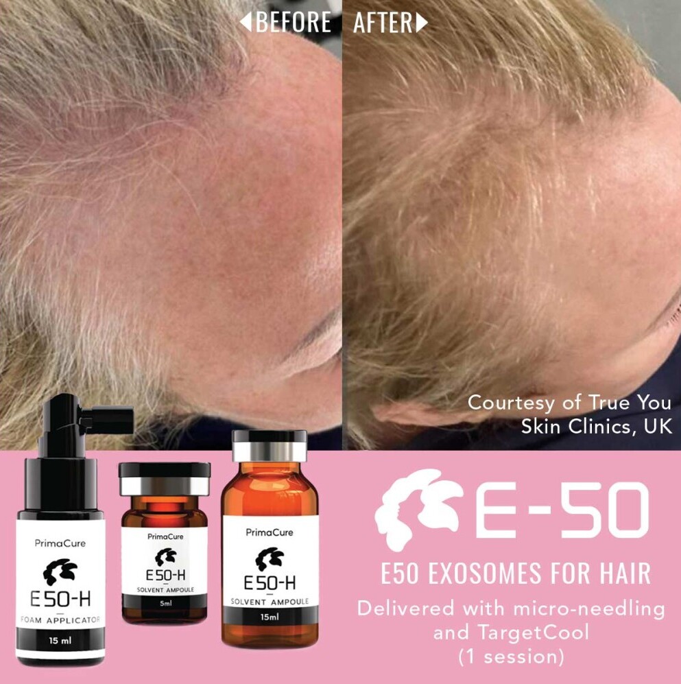 Treatment Results with E-50™️ Exosomes for Hair