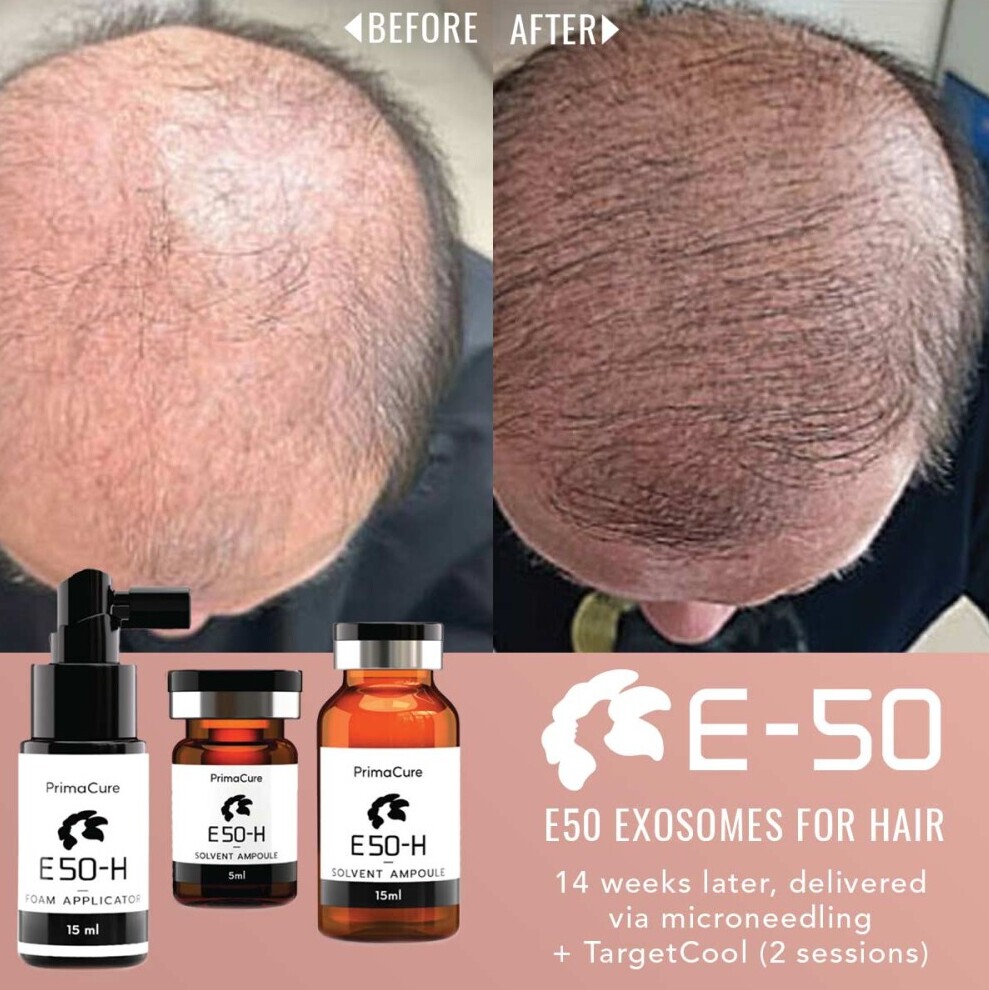 Treatment Results with E-50™️ Exosomes for Hair
